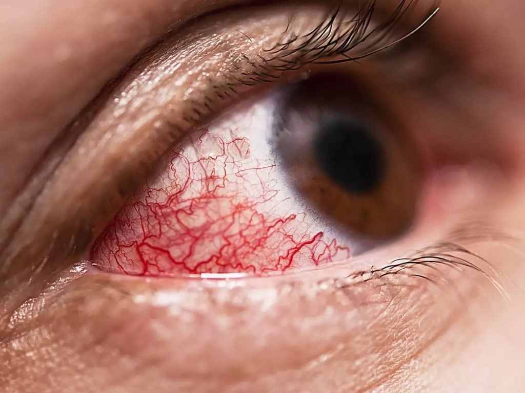 Effects of Diabetes on the Eye